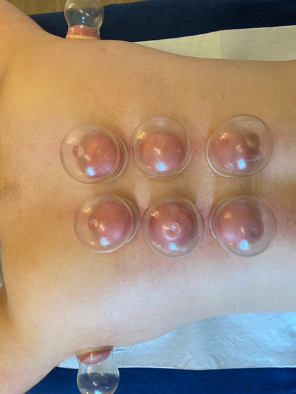 Mann erhält Schröpfkopftherapie auf dem Rücken mit mehreren Schröpfköpfen in Heilpraktikerpraxis.