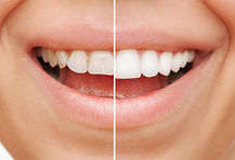 Smile Crowns.jpg