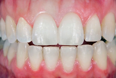 Veneers After.jpg