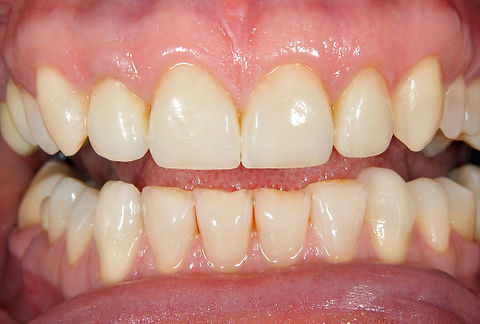 Crowns after.jpg