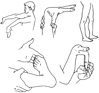 Diagram showing hypermobile joints - elbows, thumb, knees, foot, and hand.