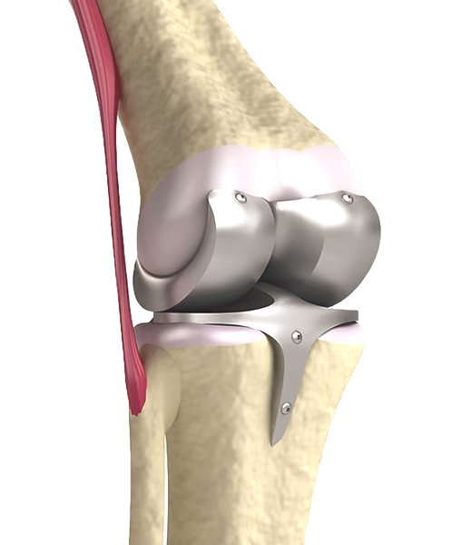 Knee replacement surgery mexico