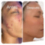 Tratamiento del acne