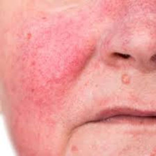 rosacea.jpeg