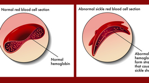Sickle Cell & School :: What Educators Need to Know