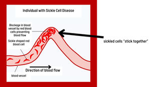 Sickle Cell Anemia & Your Child