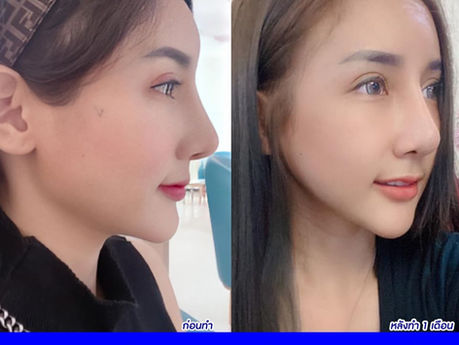 ปรับรูปหน้า ตัดกราม ลดโหนกแก้ม หน้าเรียววีไลน์ที่โรงพยาบาลยันฮี