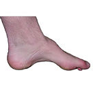 High Arched Foot Pes Cavus Charcot Marie Tooth High Instep Supinated Varus Cavoid Equino-Varus