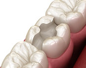 Lost Fillings