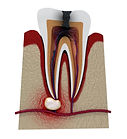 Dental Iinfections / Facial swelling