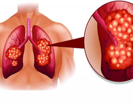 Five Common Signs of Mesothelioma Cancer
