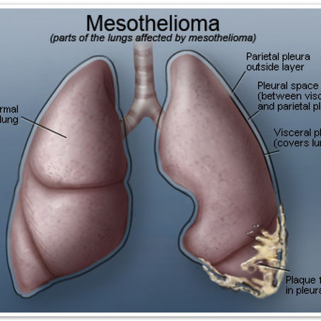 What Are The Four Phases of Mesothelioma Cancer Cells?