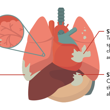 The Phases of Mesothelioma