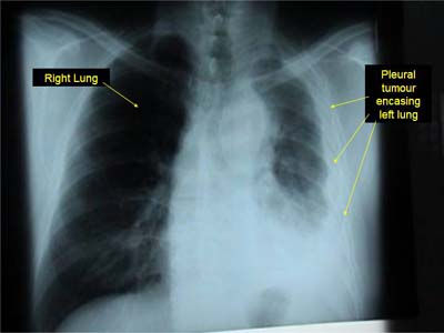 The Prognosis of Advanced Stage Mesothelioma