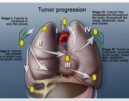 Survival Rate After Diagnosis of Mesothelioma