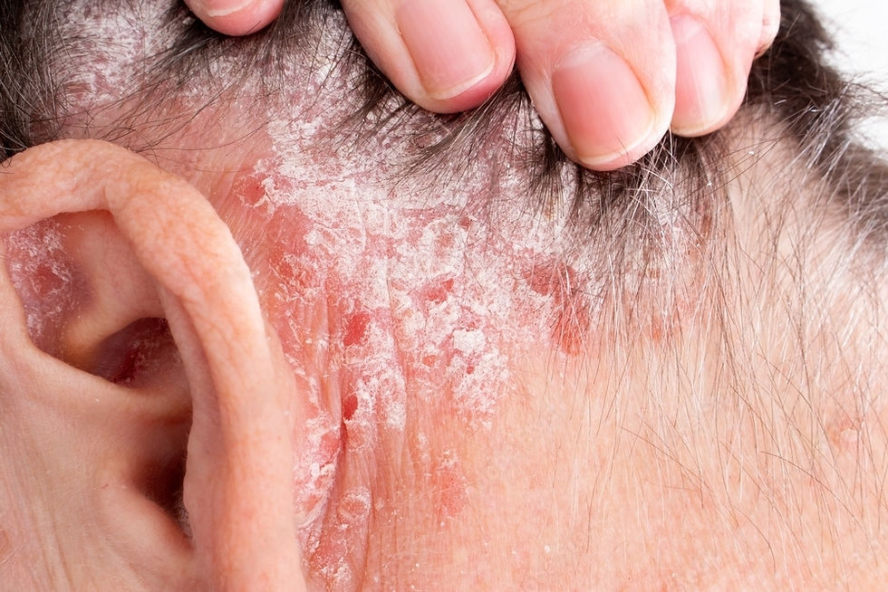 Psoriasis Around the Eyes and Ears