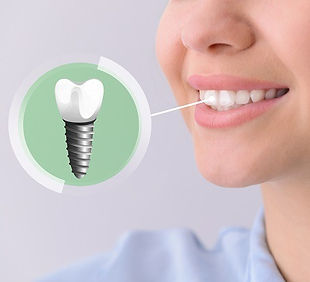 dental-implant-2305_edited.jpg