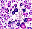 oral squamous cell carcinoma histology minimalistic.jpg