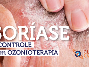 Psoríase tem controle com o tratamento com Ozonioterapia