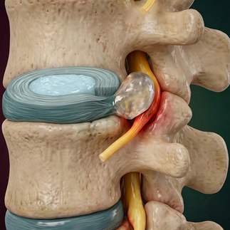 articulação da coluna com hérnia de disco