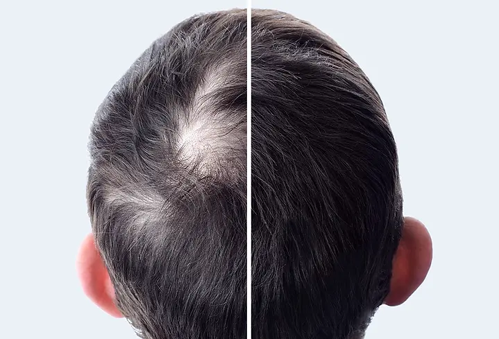 Alopecia Tricologia La Spezia, SP, Italy