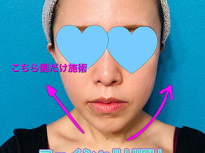 フェイシャルHIHU【ハイフ】をうつと