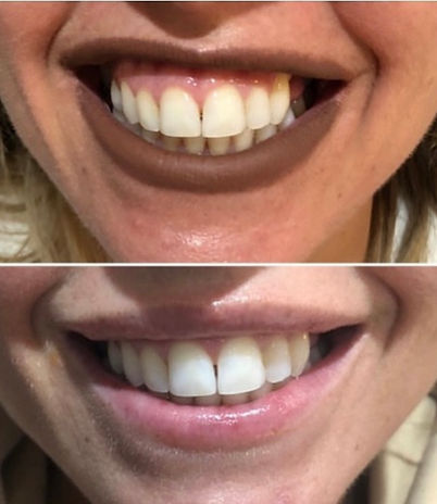 Lower face and profile balancing, gummy smile