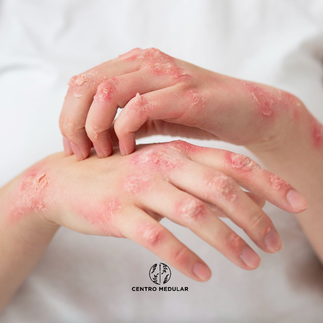 Sintomas e tratamento da psoriase - Centro Medular