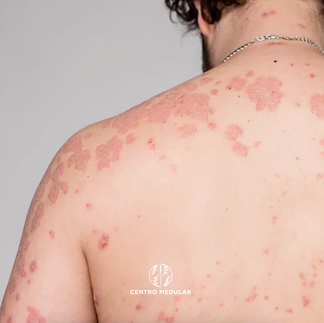 Psoriase nas costas - Centro Medular