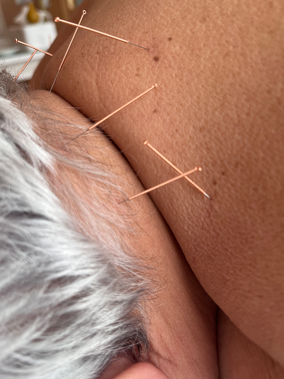 Acupuntura no Centro Medular 