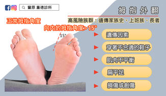 影響日常生活的足部症狀-認識拇指外翻