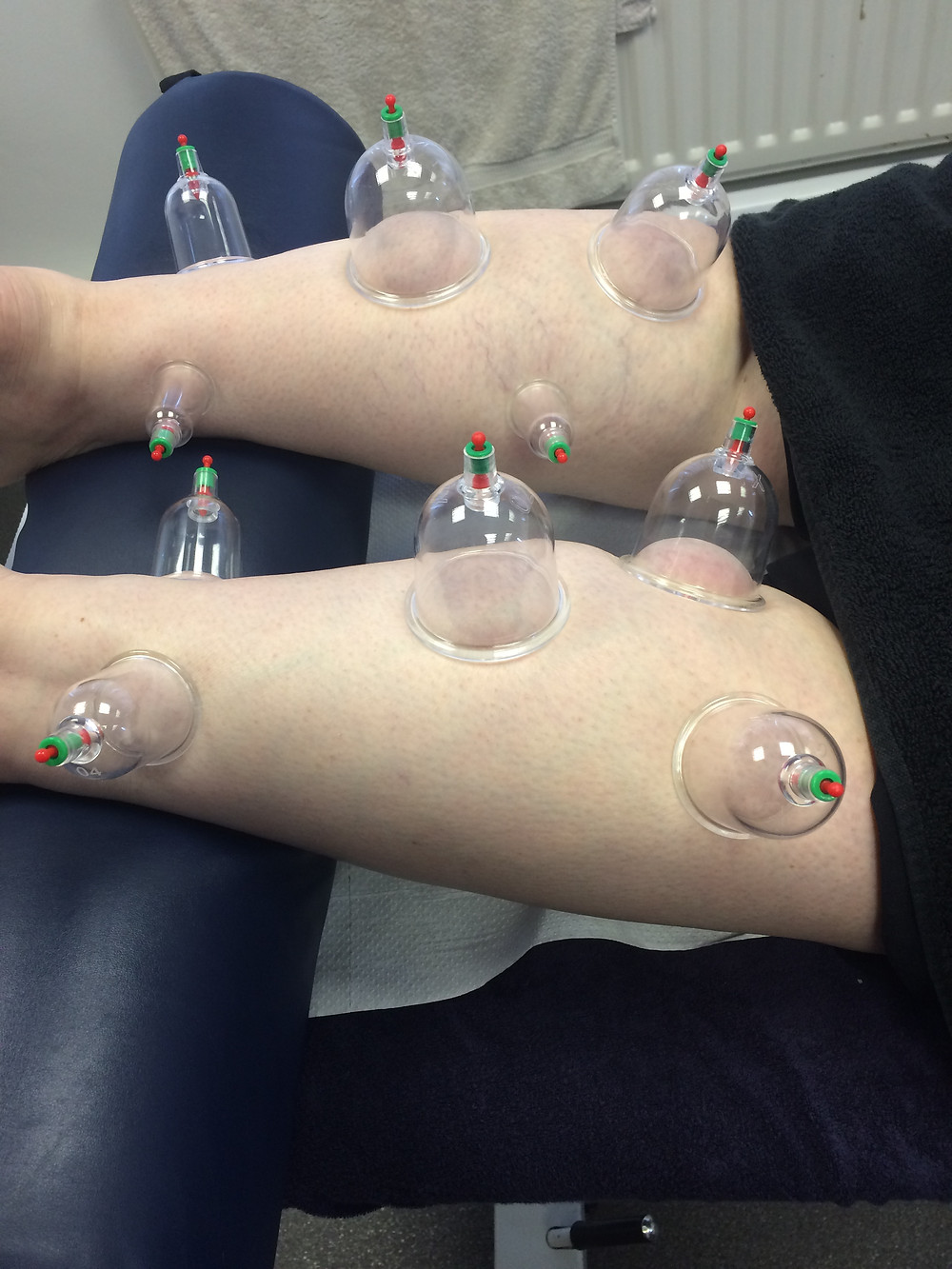 Cupping at SV Sports Therapy