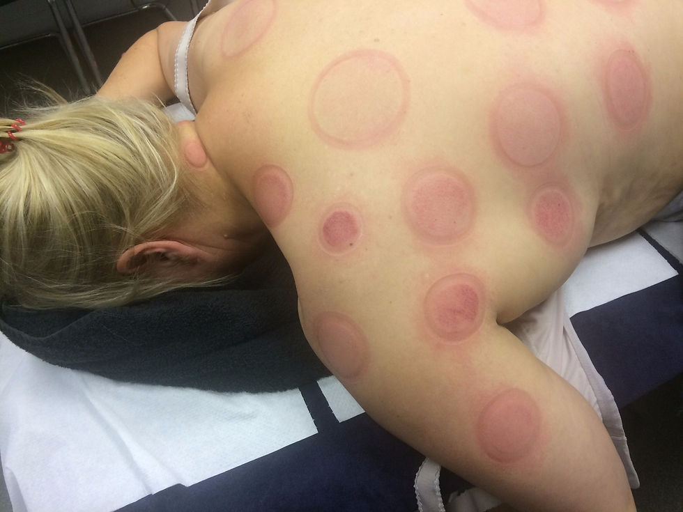 Cupping at SV Sports Therapy