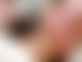 El Poder de Completar tu Tratamiento Morpheus 8 Pro: ¿Por qué son necesarias las 3 sesiones?