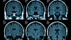 Could Irlen Syndrome Be the Hidden Cause of Your Reading Difficulties and Light Sensitivity?
