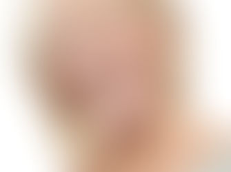 Sinus Lift for Successful Implants