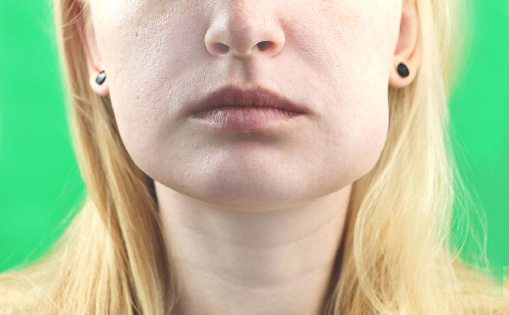 Swelling after dental surgery information