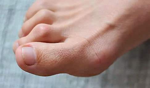 hammer toes