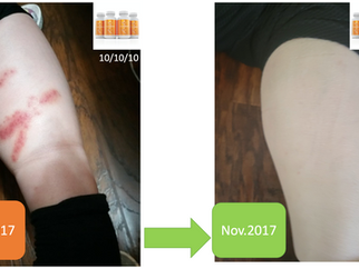 항암치료 디톡스