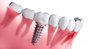 Best implant dentist in India 