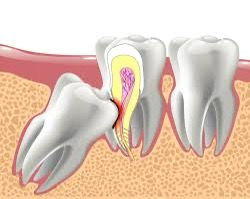 Treatment of impacted teeth in chandigarh