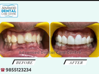 Smile Makeover in Chandigarh | Before & After Cases | Advanced Dental Care Center India