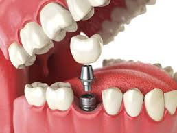 Best dental implants in Mohali