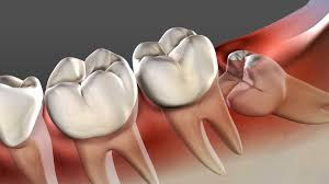 Wisdom teeth removal chandigarh , cost of wisdom tooth removal Chandigarh, best dentist for wisdom tooth removal Chandigarh