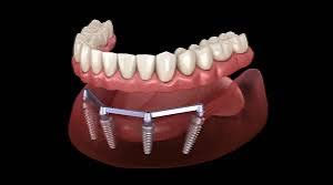 Bar denture in Chandigarh