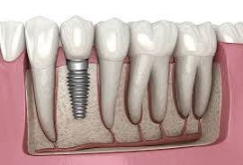 Best dental implant treatment in Chandigarh- all you need to know