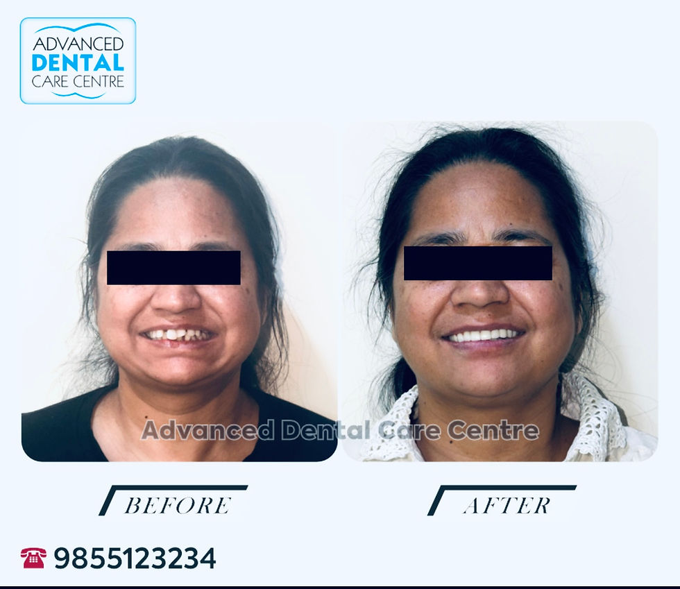 All-on-4 Dental Implants in India for Aggressive Periodontitis | Full Mouth Reconstruction Chandigarh