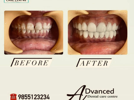 Fluorosis Treatment in India: Why Veneers Work When Whitening Fails | Advanced Dental Care Center Chandigarh