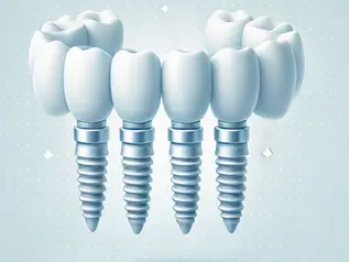 Cost of All-on-4 Implants in Chandigarh vs Abroad – Why NRIs Save Up to 80%