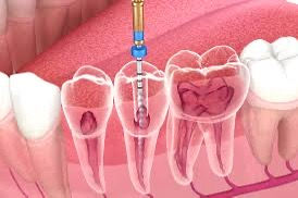 Best Root Canal Service Doctors in Chandigarh 